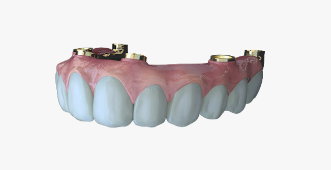 An Evo Solution dental implant. Image via Evo Dental.