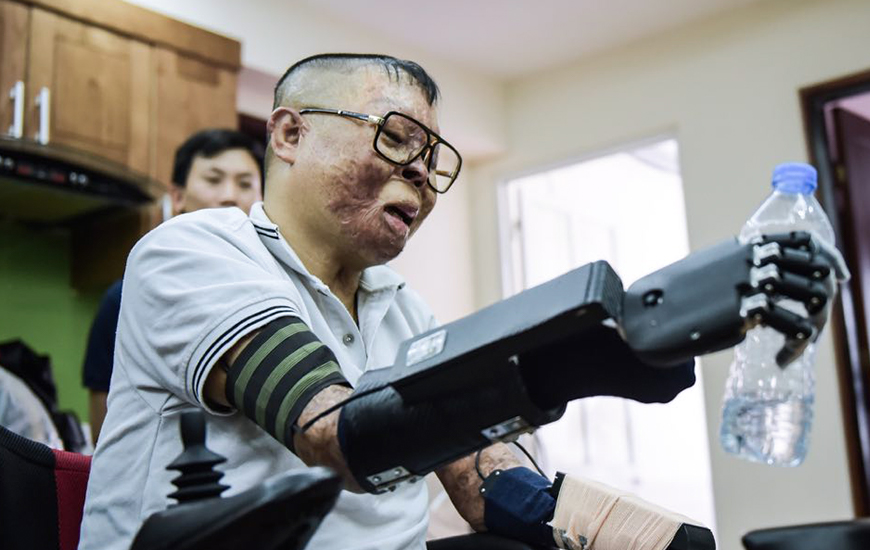 Duong picks up a water bottle using 3D printed bionic arm