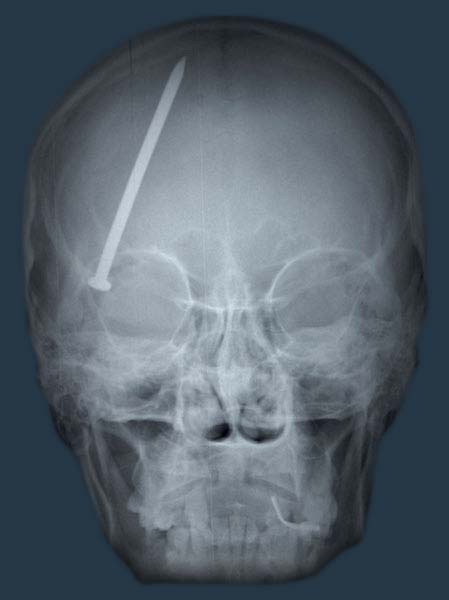 A CT scan of a nail in the head causing a TBI. Image via Qrons.